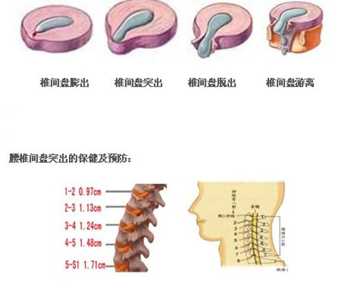 腰间盘突出最新疗法，自然美景探索之旅的治愈力量探索